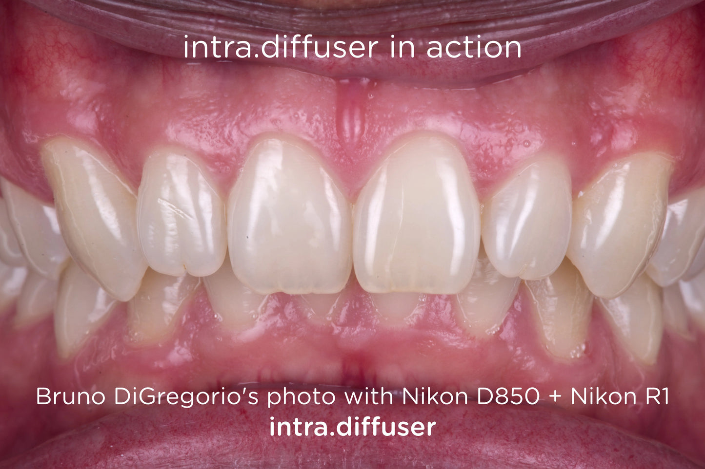 intra.diffuser + intra.polar twin combo