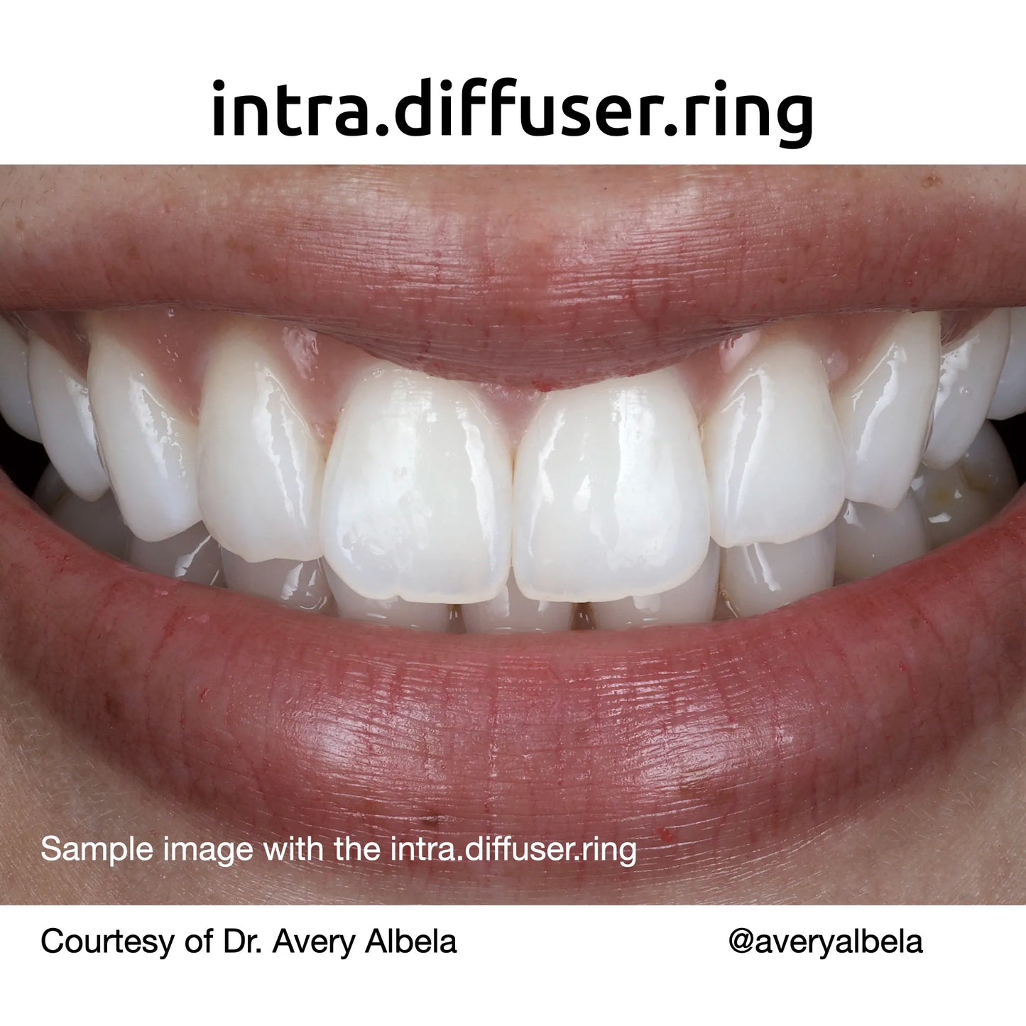 intra.diffuser kit - Flash diffuser – intra.photos